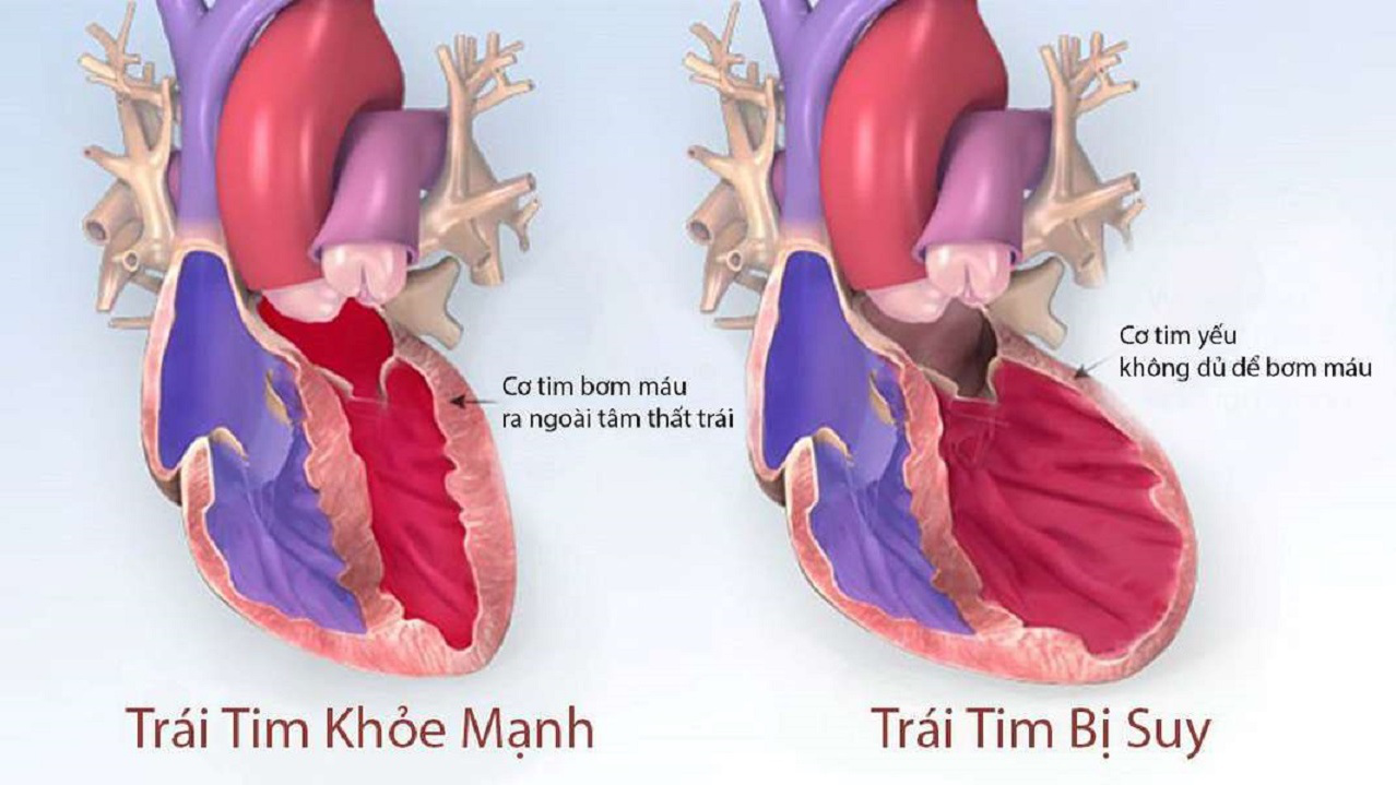 Suy tim sung huyết là tình trạng phổ biến và nguy hiểm.webp